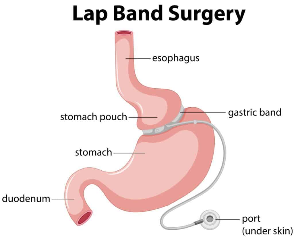 gastric sleeve requirements